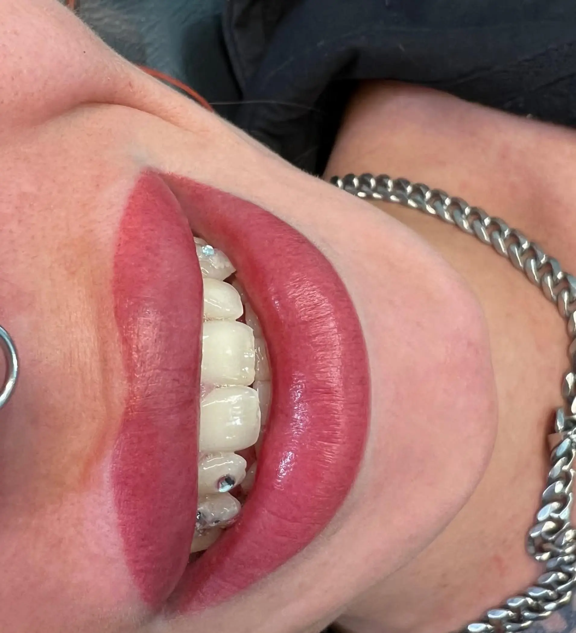 lip neutralisation before and after